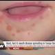 Hand, foot and mouth disease spreading in Tampa Bay area 
