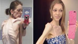 anorexic teens|Teen Credits Falling in Love Remarkable Recovery From Anorexia