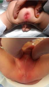  child anus|Rectal Disease in Children