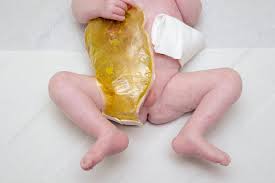  child anus|Significance of the 'line sign' in the diagnosis of congenital imperforate  anus on prenatal ultrasound | BMC Pediatrics | Full Text