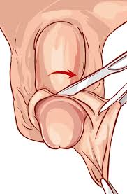 Отрезание пениса|Обрезание крайней плоти при сахарном диабете - фото До и После операции в  клинике «Открытая урология»