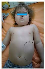 Precocious puberty boy penis　|Is Penis Size Genetic? Factors Influencing Penis Size