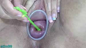 Asian anal prolapse jpg x Asian anal prolapse