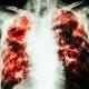 TB: Major global health problem 