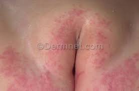 diaper rash naked |Butt Naked Baby Organic Perfect Paste for Diaper Rash | Protects Against  Wetness, Chaffing & Irritation