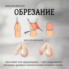 Отрезание пениса|Фимоз ─ лечение - ММТ Госпиталь