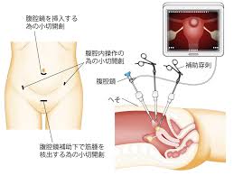 子宮口精子注射画像|Timing Aid | 自宅でできる、ふたりではじめる妊活。サガミの妊活商品情報サイト