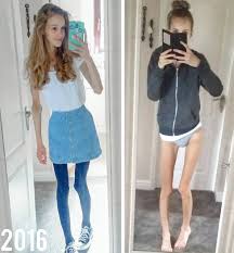 anorexic teens|I didn't want to be the anorexic girl': Woman reveals how she won fight  against eating disorder - The Mirror
