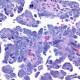 Breast Cancer Gene Raises Uterine Cancer Risk Too 