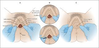 hymen child|Genitourinary Assessment: An Integral Part of a Complete Physical  Examination - Journal of Pediatric Health Care
