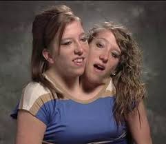 Conjoined twins jpg x Joined twins