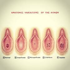 hymen child|Unusual presentation of a septate hymen leading to a retained vaginal  tampon in the urinary bladder | BMJ Case Reports
