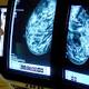 Women diagnosed with breast cancer after 70 twice as likely to die from it 