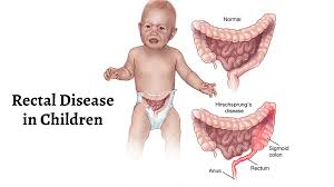  child anus|Anal Fissure in Children: Care Instructions | Kaiser Permanente