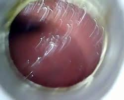 Free anal endoscope three porn video jpg x Endoscope anal