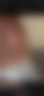 tiny puff nipples|Puffy nipples in men: Remedies and causes