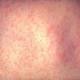 Person infected with measles visited Toowoomba 