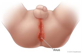  child anus|Posterior Sagittal Anorectoplasty for Acquired Imperforate Anus Complicated  by Anorectal Necrosis: A Case Report