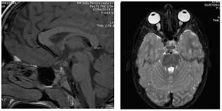 Precocious puberty boy penis　|Signs of Puberty: What Happens to Your Body?