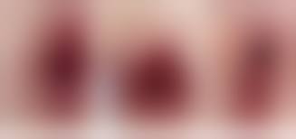 prepubertAL VAGINA|Treatment of Prepubertal Labial Adhesions with Topical Estriol +  Testosterone: A Case Report