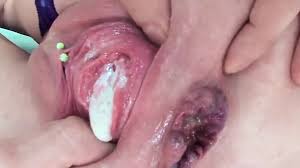 Videos prolapse suck jpg x Prolapse sucking