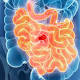 Scientists uncover five new genetic causes of bowel cancer - News