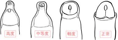 中学生包茎ちんこ|子どもの包茎の話し | こだいら泌尿器科