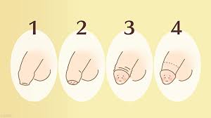 中学生包茎ちんこ|包茎｜神戸市東灘区 摂津本山｜いしむら腎泌尿器科クリニック