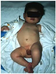 赤ちゃん　股間|先天性股関節脱臼の診断