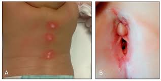 hymen child|Microperforate Hymen: A Rare Case of Pregnancy and Miscarriage | Cureus