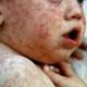 Report: US Plagued by 20-Year High in Measles Cases