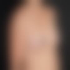 mini tits|Mini Breast Augmentation | Dallas Breast Aug Specialist | Dr. Burns – Dr  John Burns