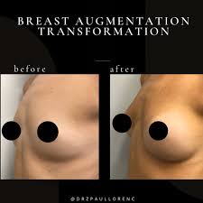 mini tits|Mini-puberty of infancy in a 16-month-old girl with prominent breast... |  Download Scientific Diagram