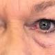 'Second Skin' May Reduce Wrinkles, Eyebags, Scientists Say 