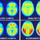 New Imaging Technique May Find Real Alzheimer's Culprit 