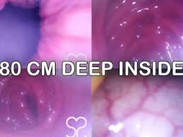 Free anal endoscope porn videos page from thumbzilla jpg x Endoscope anal