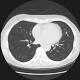 Many family doctors have poor knowledge about LDCT lung cancer screening - News