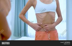 anorexic teens|Anorexic Teen Was Rushed to Emergency–Became Fitness Guru After Making  Incredible Recovery | The Epoch Times