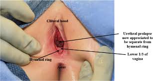 prepubertAL VAGINA|Anatomical terms for structures of the prepubertal female introitus.... |  Download Scientific Diagram