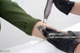 remove tattoo stock|Laser Tattoo Removal: Everything You Need to Know - SD Botox