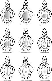 child hymen |Hymen and virginity: what every paediatrician should know
