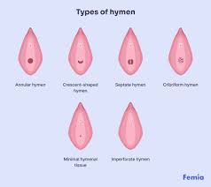 child hymen |Genitourinary Assessment: An Integral Part of a Complete Physical  Examination - Journal of Pediatric Health Care
