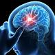 9 Of 10 Strokes Are Preventable, Study Finds 