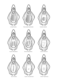 hymen child|Figure 1 from A normal ano-genital exam: sexual abuse or not? | Semantic  Scholar