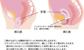 子宮脱|58 : 膣脱・子宮脱整復手術 / 【出産後の膣脱・子宮脱】 | 林動物病院