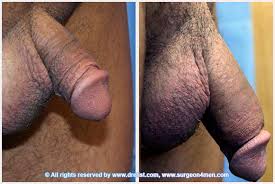 Screen shot at copy png jpg x Penile implant