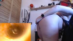 Endoscope anal jpg x Endoscope anal