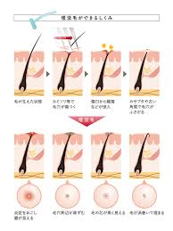 小学生　中学生　女子　腋毛|バレエ脇毛処理】正しい処理方法を解説！小中学生にもおすすめの方法 ｜ちこまバレエ三姉妹