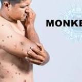 Monkeypox outbreak: Is it still possible to control it? Here's what Ex-FDA chief has to say