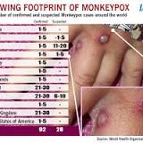 Experts warn of unusual Monkeypox outbreak in Australia, WHO confirms 92 cases